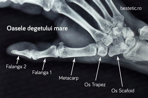 osteoartrita deformantă a articulației genunchiului de gradul 3 unguent pentru durerile articulare